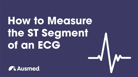 How To Measure The St Segment Of An Ecg Ausmed Explains