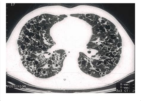 High Resolution Computed Tomography Hrct Scan Of A Pulmonary