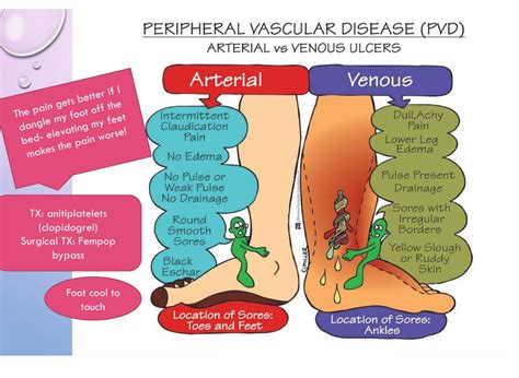 The 25 Best Vascular Disease Ideas On Pinterest Peripheral Artery