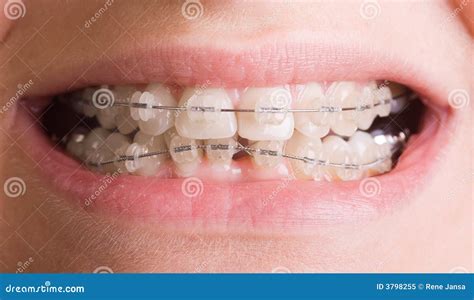 Smile With Braces Stock Image Image Of Colour Orthodontic 3798255