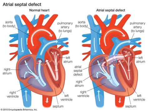 Cardiovascular Disease Abnormalities Heart Chambers Risk Factors