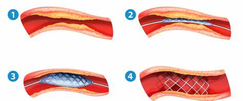 Кому показано стентирование сосудов сердца? Картинка - Кому показано стентирование сосудов сердца?