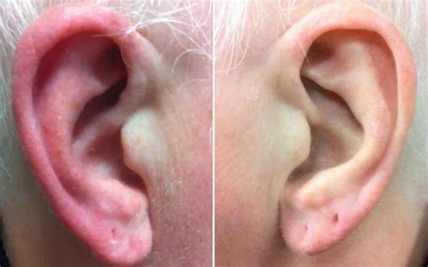 Natural Remedies For Rash Behind Ear 7 Best Solutions