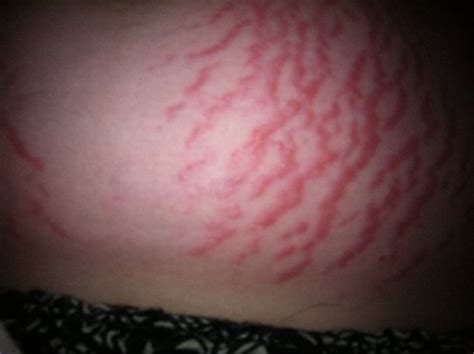 Infected Stretch Marks Pic Babycenter