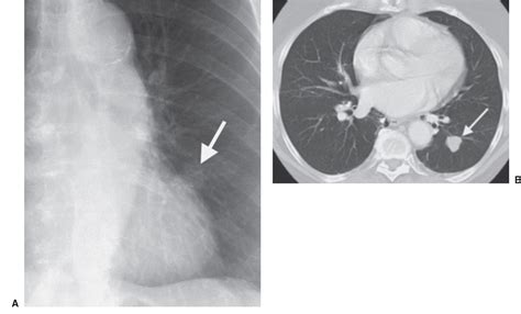 The Malignant And Benign Lung Nodules Of Computed Tom