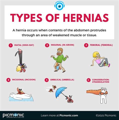 Can You Recall The Different Types Of Hernias Save This Post So You