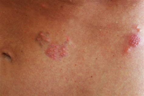 Shingles Symptoms And Treatment Options Hot Sex Picture