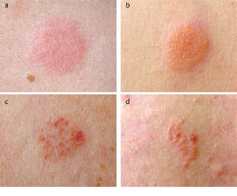 Allergic Contact Dermatitis Causes Scaling Lesions 2 At Touro