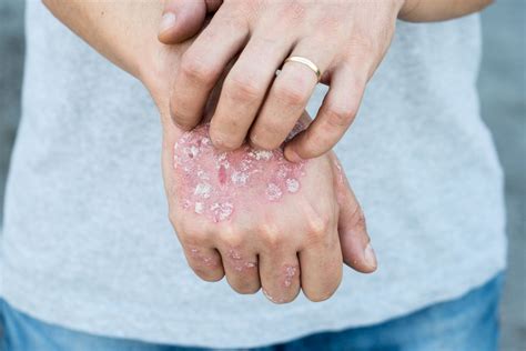 Psoriasis 101 Symptoms Causes Treatments And Pictures