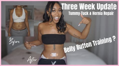 3 Week Tummy Tuck Update Belly Button Training Youtube