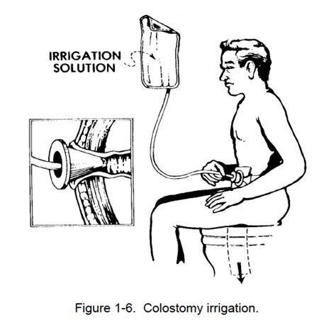 1 45 Colostomy Irrigation Nursing Care Related To The Gastrointestinal And Genitourinary Systems