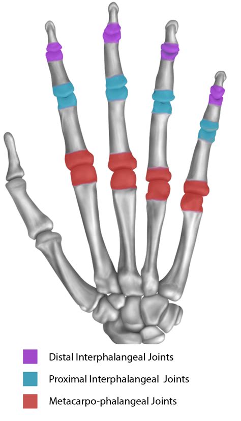 Osteoarthritis In The Hand Fife Virtual Hand Clinic