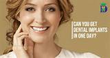 Can Dental Implants Be Done In A Day