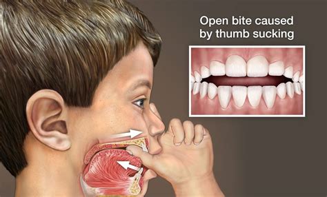Treatment For Thumb Sucking Teeth Tetsumaga