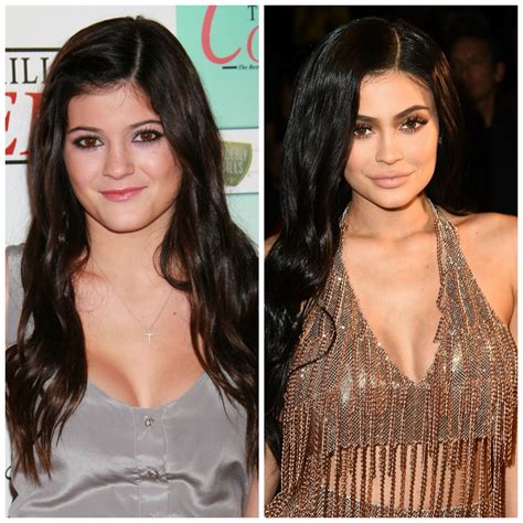 Kylie Jenner Before Plastic Surgery Fans Think She Went Under The Knife
