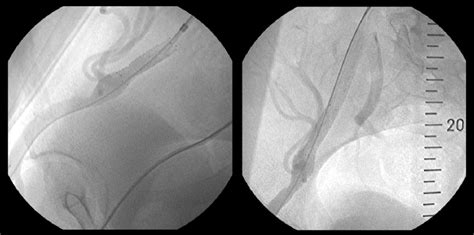 External Iliac Artery After Percutaneous Transluminal Angioplasty