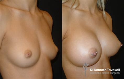 Nipple Conditions Nipple Surgery Sydney Sydney Nipple Surgeons
