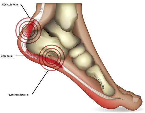 HEEL PAIN CAUSES TREATMENTS AND HOW INSOLES CAN HELP My Foot First