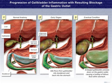 Progression Of Gallbladder Inflammation With Resulting Blockage Of The