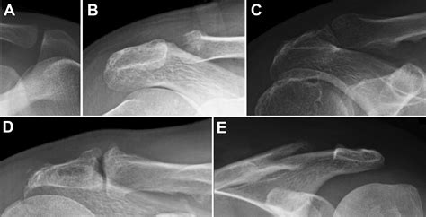 Preoperative Factors Associated With Subsequent Distal Clavicle