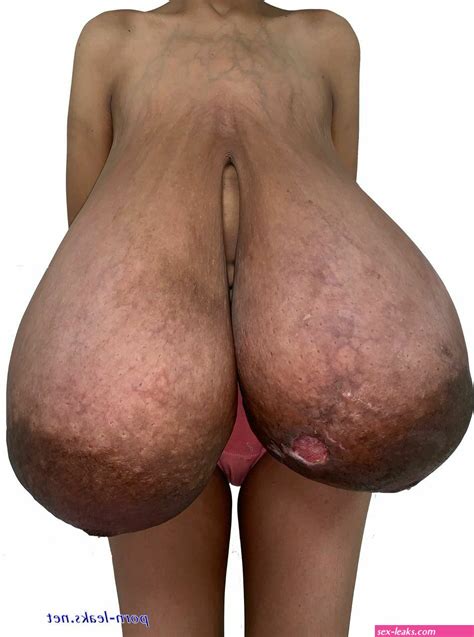 Photos Of Naked Women With Gigantomastia Sex Leaks My XXX Hot Girl