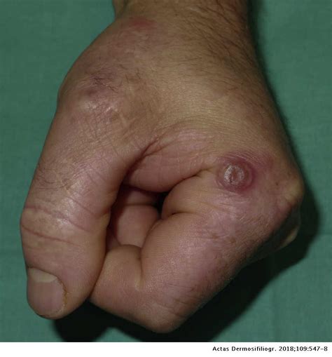 Solitary Lesion On The Lateral Aspect Of The Index Finger Actas Dermo