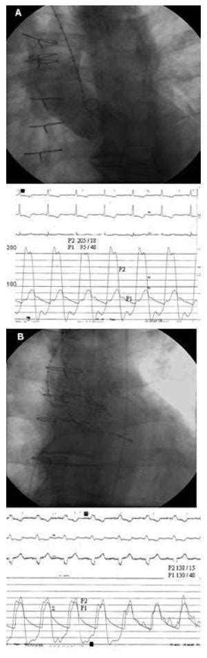 Percutaneous Aortic Corevalve Prosthesis In A Degenerated Bioprosthesis
