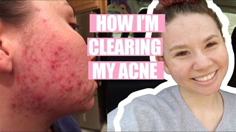My Acne Skincare Routine Youtube