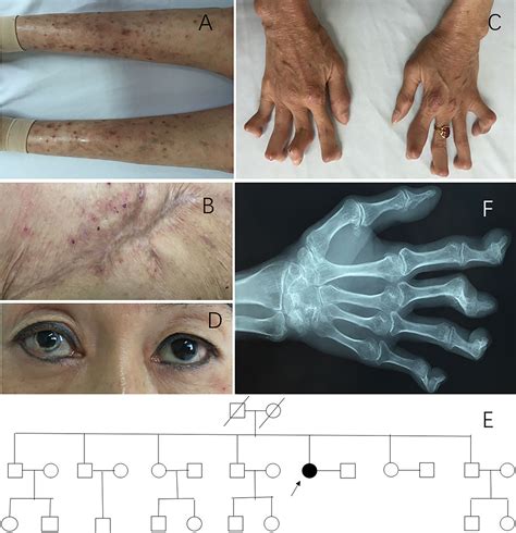 Frontiers Case Report Pyogenic Arthritis Pyoderma Gangrenosum And
