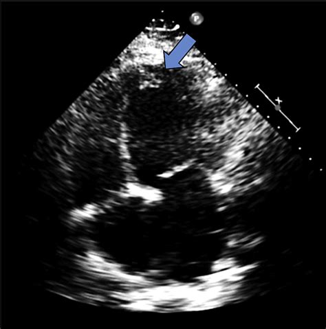 Enlarged Heart With Large Apical Mural Thrombus In The Left Ventricle