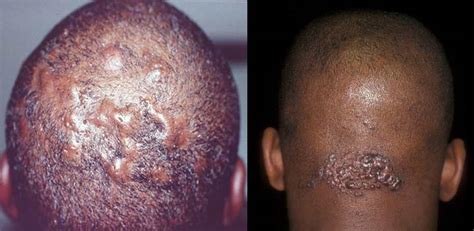 Ingrown Hair On Head Scalp Pictures Symptoms Removal And Treatment