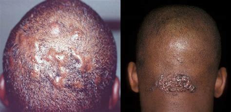 The condition is most prevalent among people who have coarse or curly hair. Ingrown Hair on Head Scalp Pictures, Symptoms, Removal ...