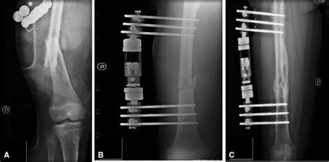 A Open Femur Diaphyseal Fracture In A 15 Year Old Boy B Treatment With