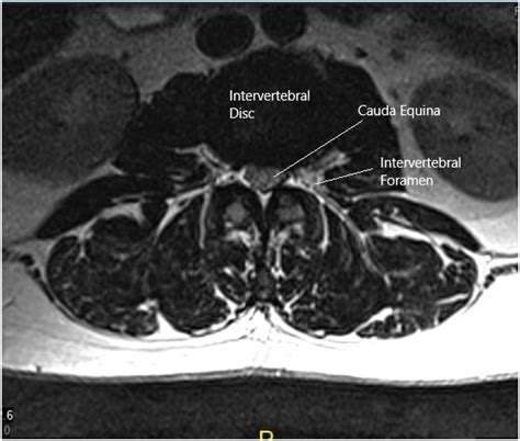 Case Study Management Of 50 Year Old Male With Cauda Equina Syndrome