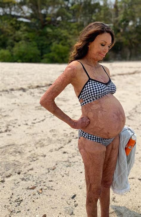 Turia Pitt Shows Off Pregnancy Bump In Stunning Bikini Beach Photo The Advertiser