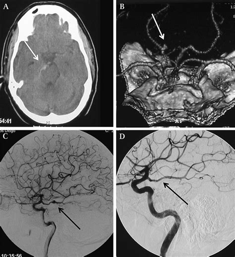 Posterior Cerebral Artery Dissecting Aneurysm Another Cause Of
