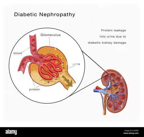 Diabetic Nephropathy Illustration Of A Kidney Damaged By Diabetes