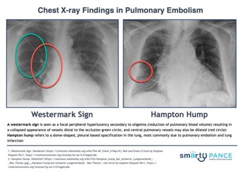 Pulmonary Circulation Pearls Pulmonary System Smarty Pance