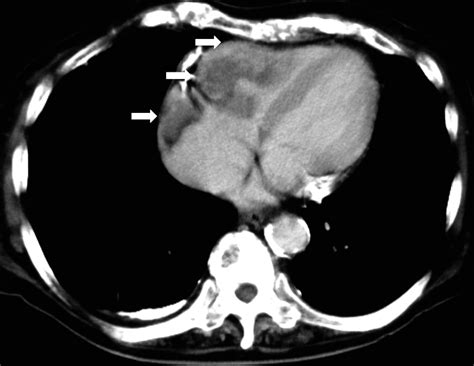 Contrast Enhanced Chest Computed Tomography Image Obtained 4 Months