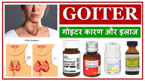 Goiter Iodine Deficiency गोइटर कारण और इलाज Causes Symptoms