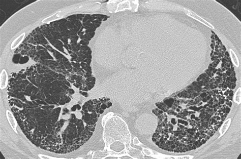 Medicare Oks Coverage Of High Risk Ct Lung Screening Massdevice