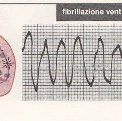 La rapidità e la disorganizzazione dell'impulso elettrico. Fibrillazione Atriale | Blog sulla salute del Cuore