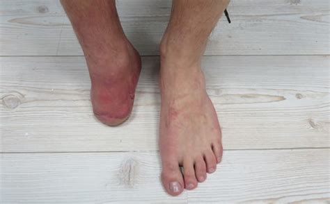 A Tillges Guide To Partial Foot Amputation Prosthetics Tillges