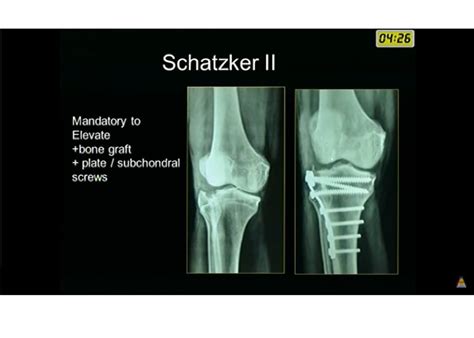 Medial Condyle Fracture Ulnar Nerve