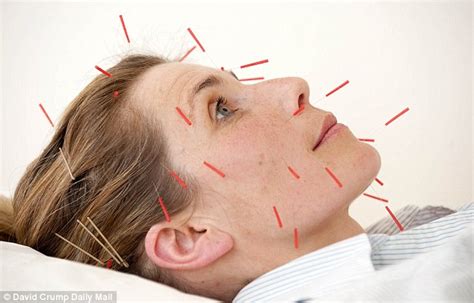 Cosmetic Acupuncture Is The Newest Weapon In The Anti Ageing War But