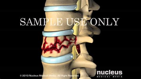 Spinal Fusion Surgery Explained Youtube