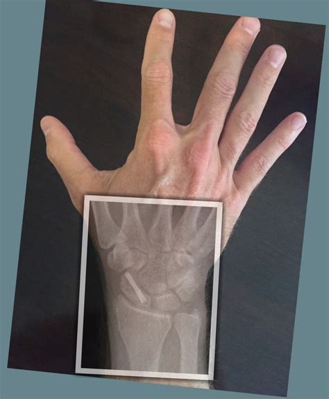 Scaphoid Fracture John Erickson Md