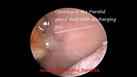 Disorder Of Salivary Gland Pus Discharge From Parotid Duct Opening