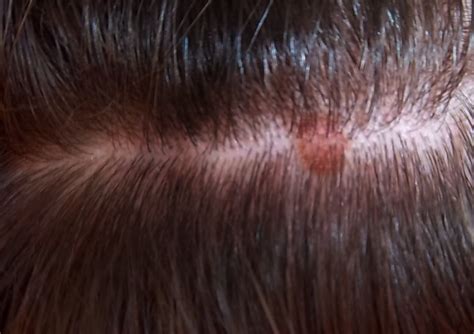 Get Rid Of Itchy Bumps On Scalp Itchy Bumps Scalps It