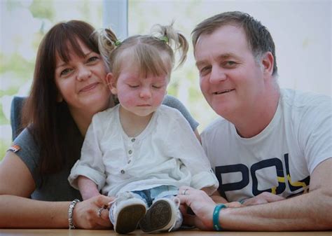 Toddler Matilda Callaghan 2 Treats Severe Birthmark With Laser